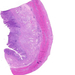 Adenocarcinoma ventriculi (diffuse type)00