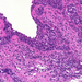 bronchus-metaplasia-dysplasia-carcinoma2