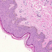 haemangioma capillare cutis norm