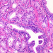 adenocarcinoma prostatae myoepithel