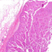 carcinoma transitiocellulare izomréteg