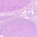 cirrhosis hepatis epeút-proloferáció