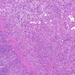 Adenocarcinoma ventriculi (diffuse type)0