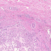 haemangioma capillare cutis átmenet