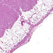 pericarditis fibrinosa